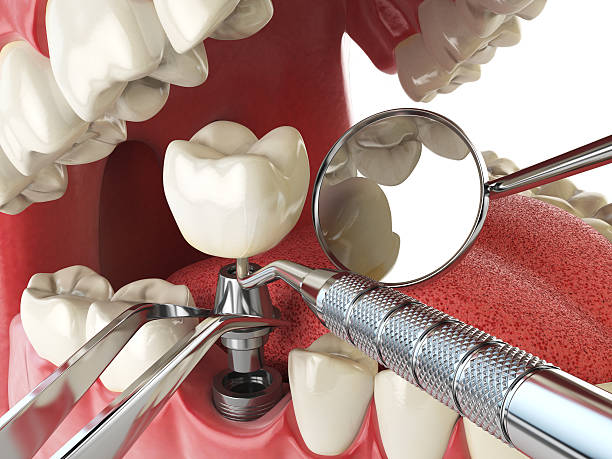 Best Emergency Root Canal Treatment in Richwood, TX